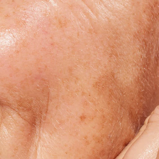 Hyperpigmentation